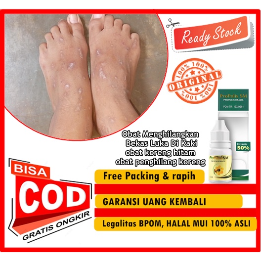 Obat Menghilangkan Bekas Luka Di Kaki, obat koreng hitam, obat penghilang koreng, menghitam, luka ko