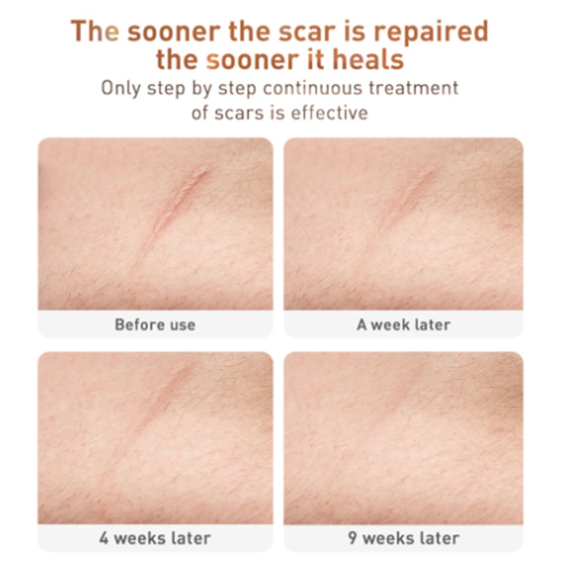 LANBENA ORIGINAL Penghilang Bekas Jerawat &amp; Luka / TCM Scar and Acne Mark Removal Gel