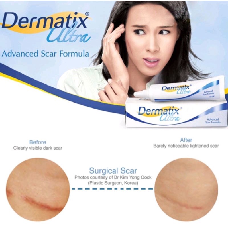 Jual Dermatix Ultra Gel 15g Penghilang Bekas Luka Keloid Anti Scar Stretchmark 15 Gram 