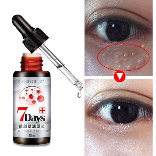 Obat Milia Penghilang Milia Bintik Bintik Di Wajah Penghilang Beruntusan