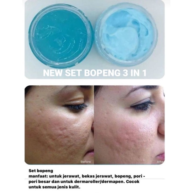 [WAJIB KONSULTASI/TIDAK DIJUAL BEBAS] PAKET BOPENG 3 IN 1 HIGH QUALITY NON BUMIL BUSUI  || SKINCARE BOPENG ACNE PRIORITY