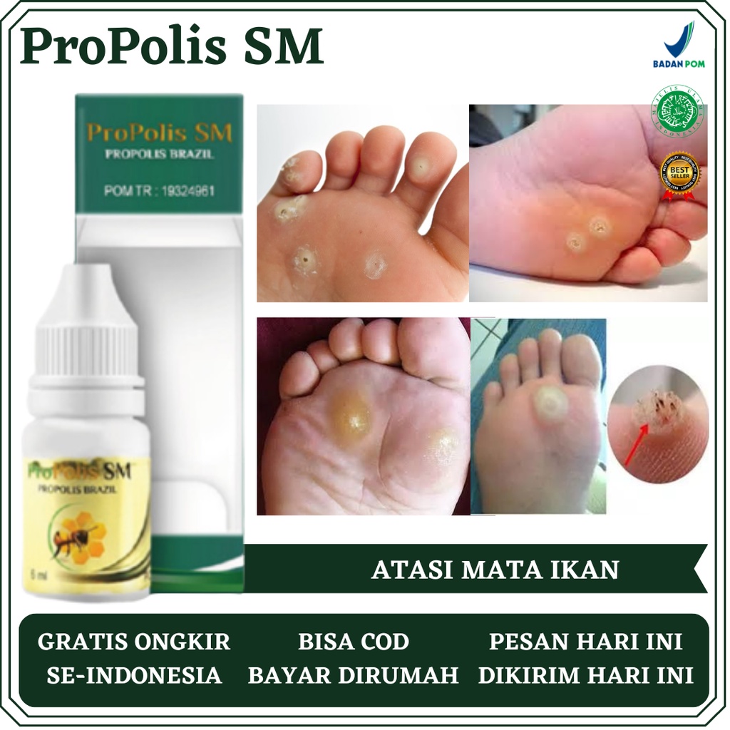 Obat Mata Ikan, Obat Perontok Mata Ikan, Obat Mata Ikan di Telapak Kaki dan Tangan, Obat Kaki Kapala