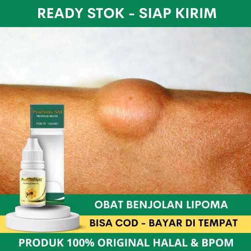 Propolis SM Obat Herbal Benjolan Lipoma / Obat Oles Lipoma