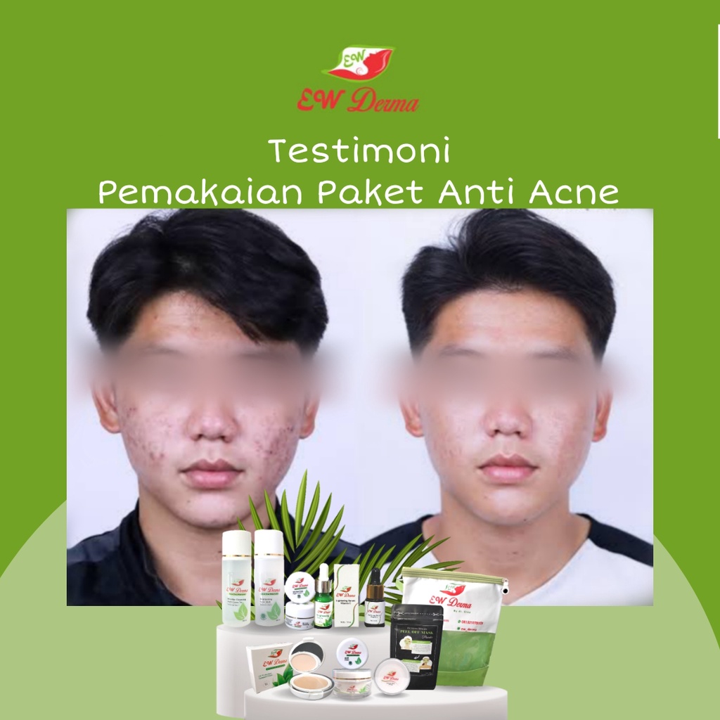 Obat Jerawat Pria Bopeng Bekas Jerawat Komedo Flek Hitam Cream Pemutih Cowok BPOM