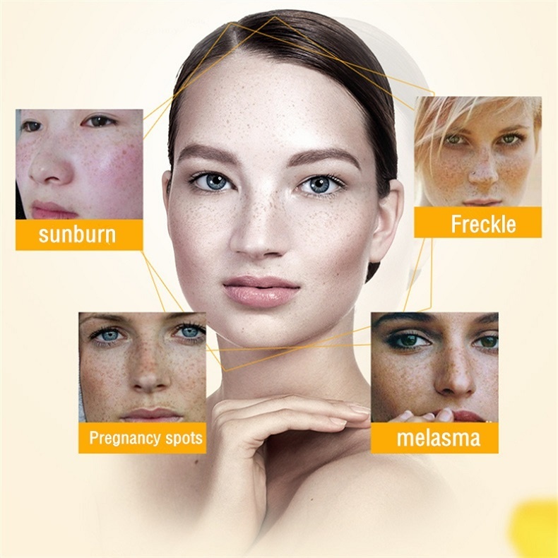 Whitening Freckle Cream Remove Dark Spots Anti Freckle Cream Niacinamide Fade Pigmentation Melasma Brighten Creams concealer