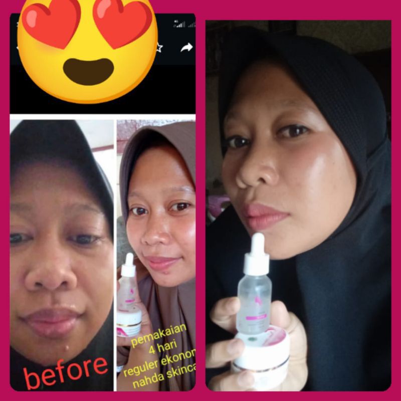 NAHDA SKINCARE PAKET ACNE + SERUM ORIGINAL BER BPOM (TERMURAH)