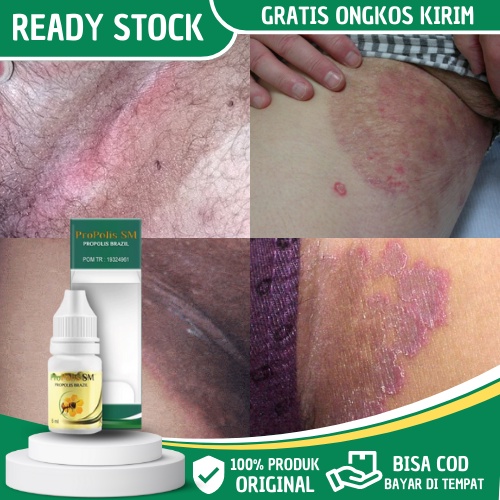 Obat Gatal Selangkangan, Obat Alergi Gatal Selangkangan, Obat Selangkangan Babak, Obat Selangkangan 