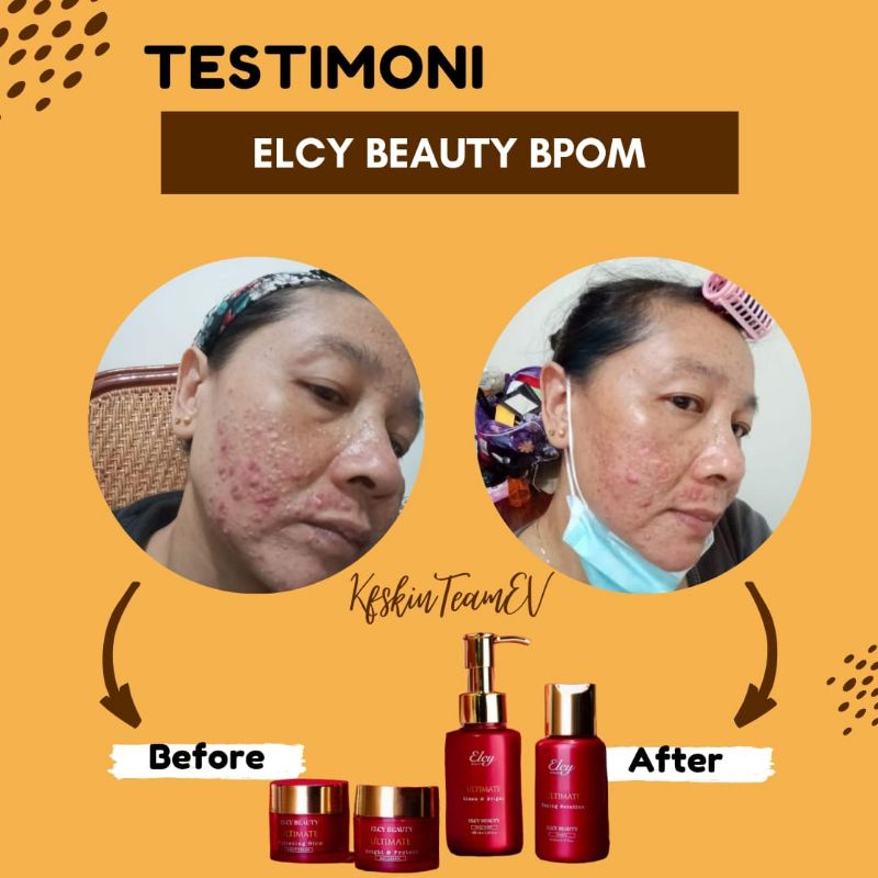 ELCY BEAUTY LC BEAUTY PAKET JERAWAT 100X LEBIH CEPAT MENGHILANGKAN JERAWAT