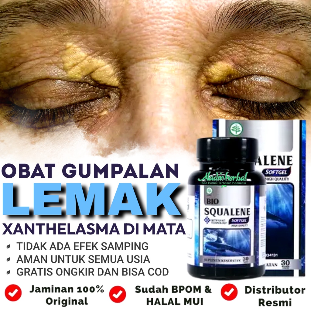 Jual Obat Xanthelasma Penghilang Gumpalan Lemak Di Kelopak Mata Obat