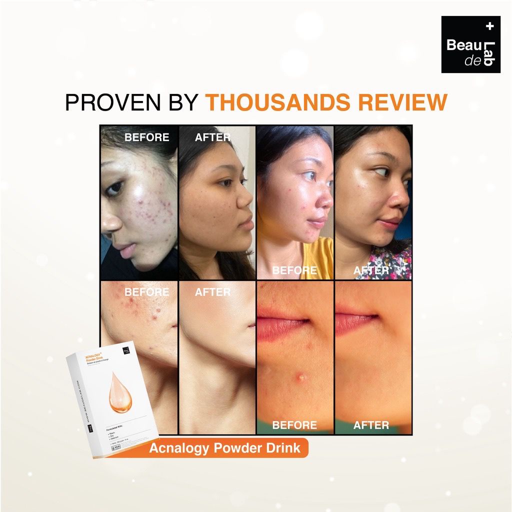 Beaudelab Acnalogy Powder Drink Obat Minum Jerawat