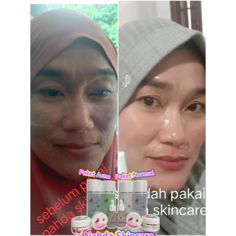 NAHDA SKINCARE PAKET ACNE + SERUM ORIGINAL BER BPOM (TERMURAH)