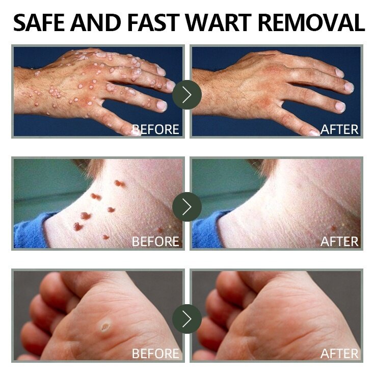 Obat Mata Ikan Penghilang Tahi Lalat Wart Removal 20g Repair And Clean Skin Tag Remover Di Wajah Menghilangkan pada mata/ wajah/ leher/ bagian tubuh/ Kapalan Di Tangan Dan Kaki Krim Antibakteri Krim Penghilang Kutil