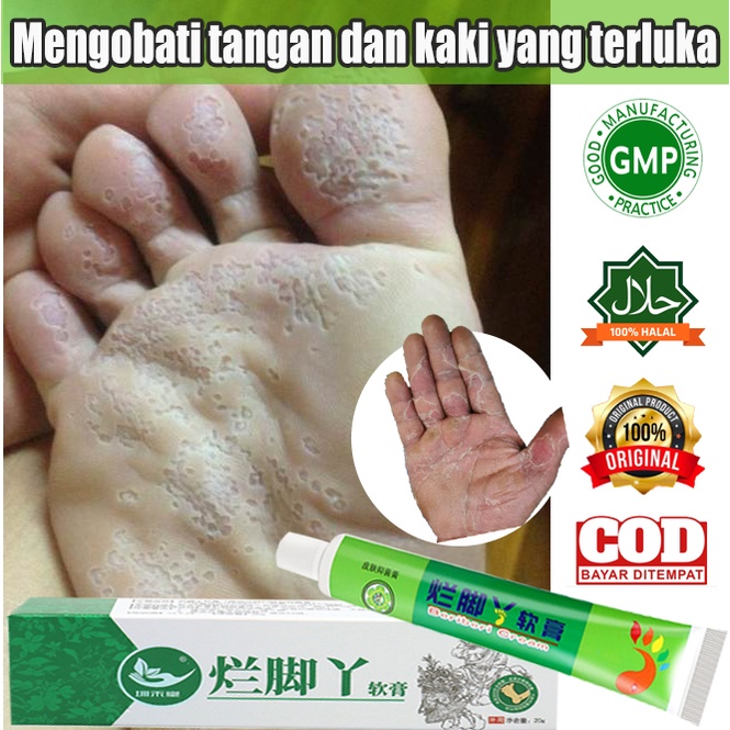 Obat Telapak Kaki Rayapan Kaki Rayapan Kaki Rayap Bau 20g Kaki Bolong Bolong Seperti Kena RayapTumit Kaki Pecah Telapak Kaki Rayapan Penghilang Kaki Rayapan Kaki Bolong Bolong Kaki Bolong Telapak Kaki Bolong, Telapak Kaki Bolong Bolong