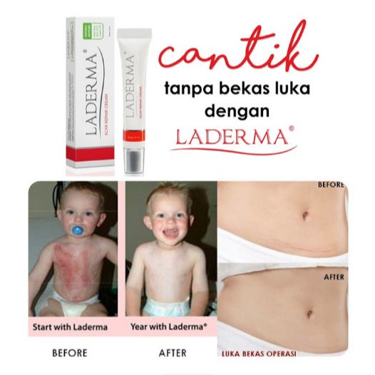 Krim bekas luka Laderma Scar Repair Cream 8ml