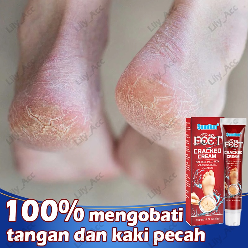 salep tangan dan kaki pecah / mengobati tumit kaki pecah , telapak tangan pecah , mengelupas, celah/ krim tangan , krim perbaikan / menghidrasi melembabkan, memperbaiki tumit kaki , telapak tangan