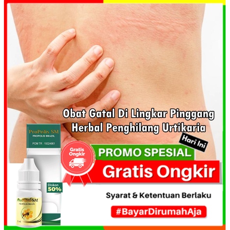 Obat Gatal Di Lingkar Pinggang, Herbal Penghilang Urtikaria Akibat Tekanan (pressure urticaria) - Al