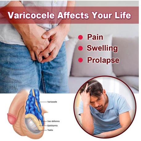 SALEP OBAT VARIKOKEL SALEP OBAT VARISES BETIS SALEP OBAT VARISES KEMALUAN