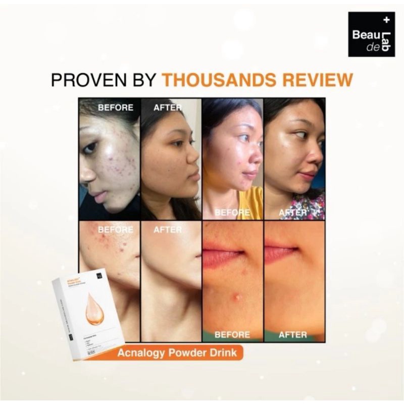 Acnalogy Newlab Beaudelab powder drink minuman serbuk anti jerawat acne