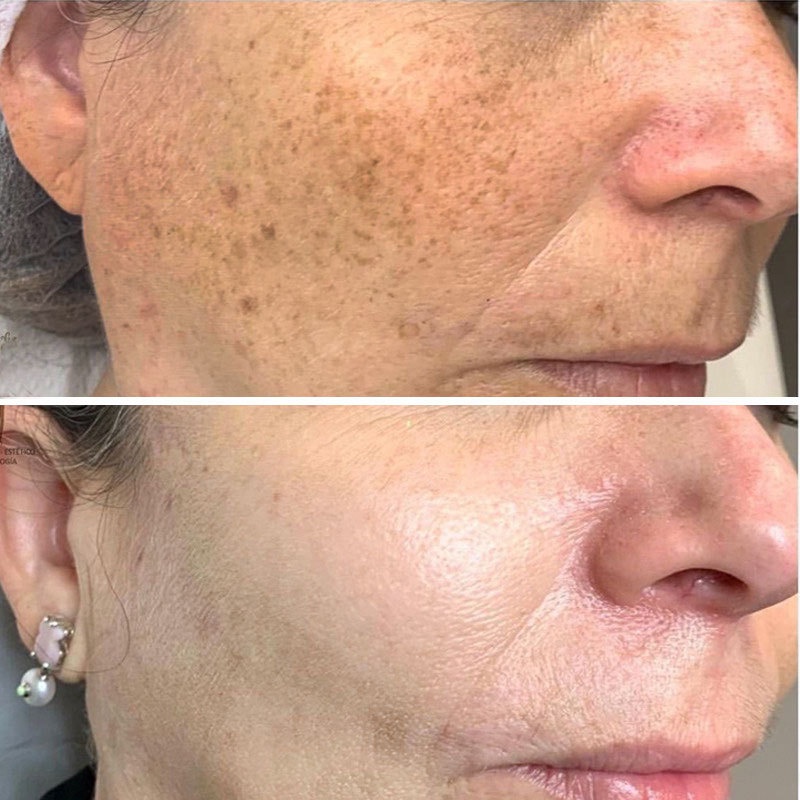 SISKALEY Nicotinamide Whitening Serum Freckles Remove Dark Spots Melasma Brighten Lighten Melanin Improve Dull Anti-Aging 15ml