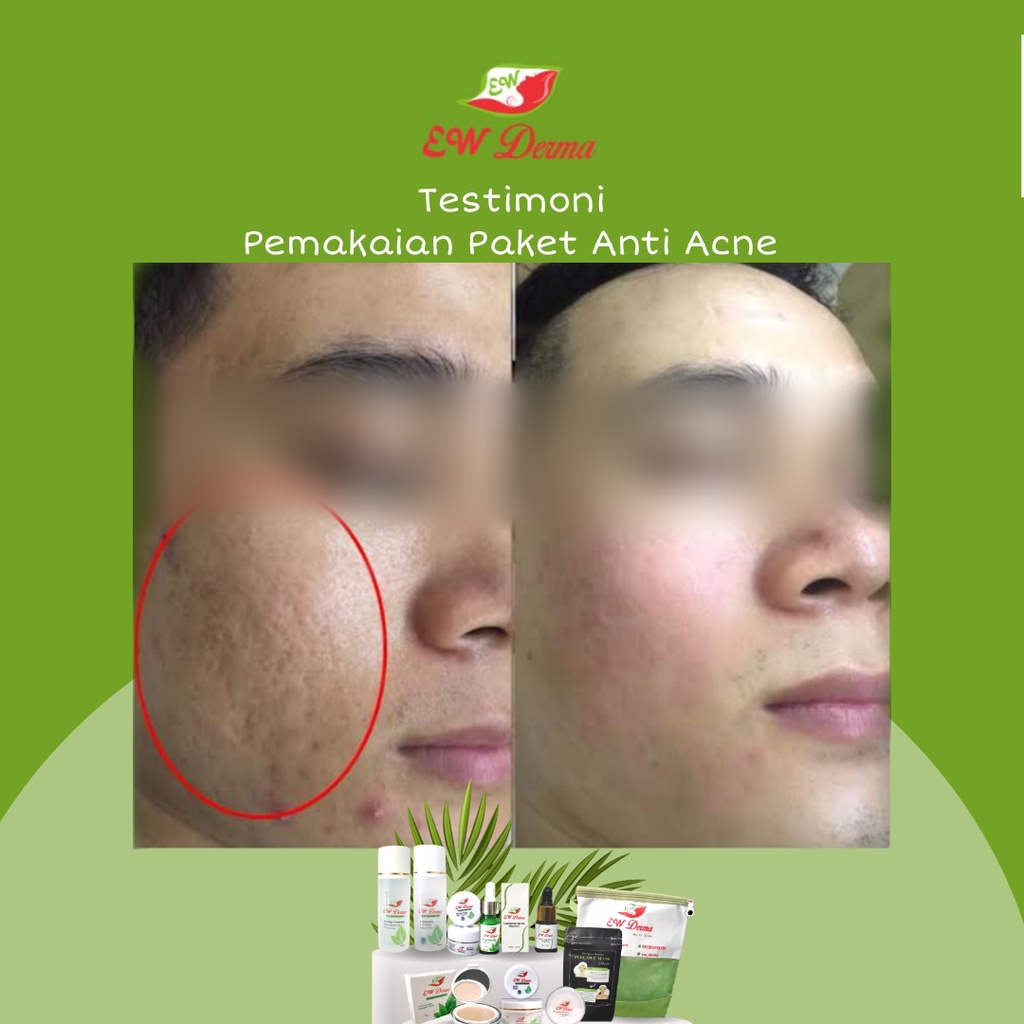 Obat Jerawat Pria Bopeng Bekas Jerawat Komedo Flek Hitam Cream Pemutih Cowok BPOM