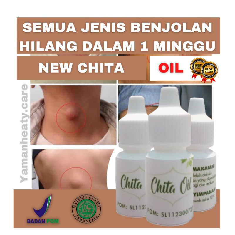 OBAT OLES BENJOLAN ORIGINAL - CHITA OIL / ATASI KELOID / ATASI UCI UCI / ATASI KISTA / ATASI KELENJA