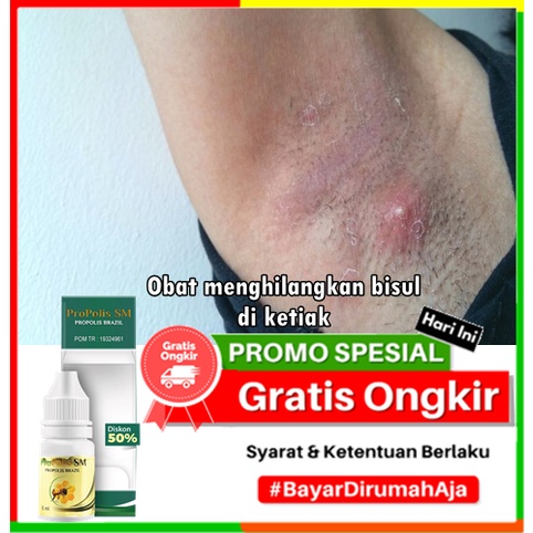 Obat Menghilangkan Bisul ‪(6)‬ Obat menghilangkan bisul di ketiak, menghilangkan bisul di ketiak, Ob