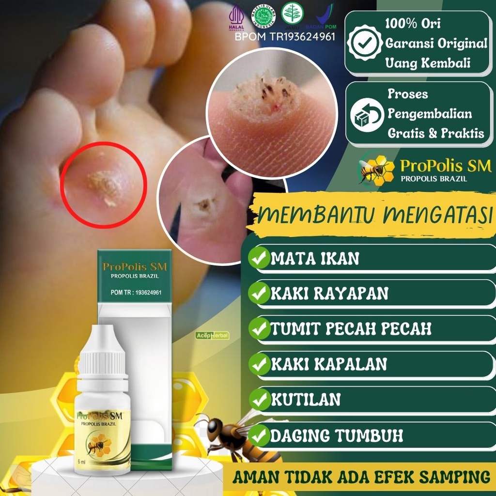 Jual Salep Cair Obat Perontok Mata Ikan Dan Kutil Di Kaki Telapak Kaki Rayapan Bolong Tumit