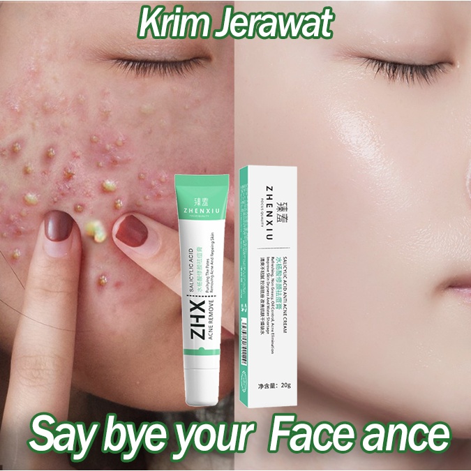 Obat Jerawat Penghilang Bekas Jerawat Bpom Acne Cream Skin Care Salep Jerawat Dan Bekas Jerawat Paling Ampuh