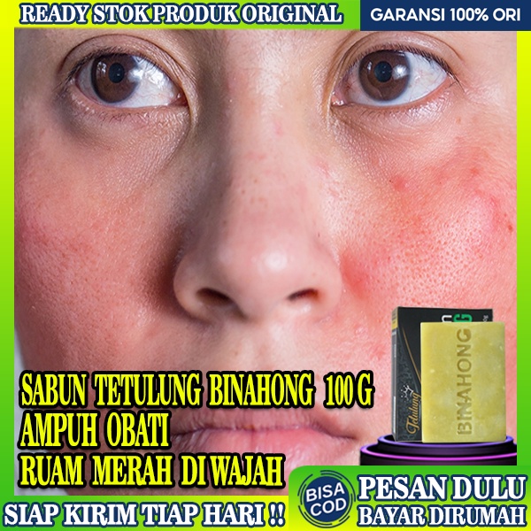 Jual Sabun Ruam Merah Di Wajah,Sabun Binahong 100g, Obat Ruam Kulit ...