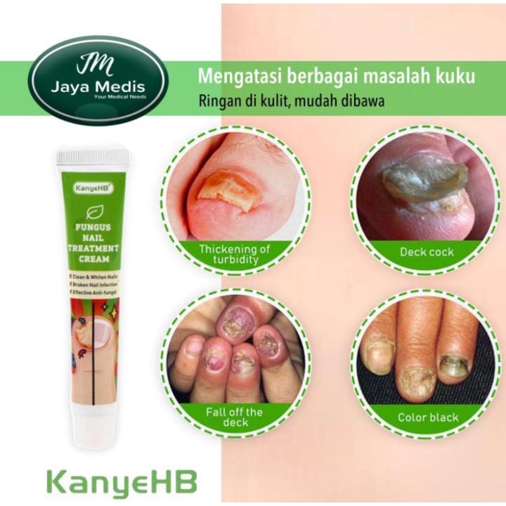 CREAM PERAWATAN KUKU RUSAK - FUNGUS NAIL TREATMENT KENYE HB