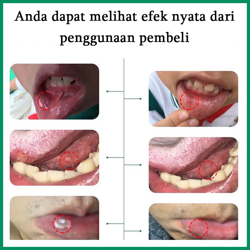 Obat sariawan mulut Perawatan mulut lainnya Spray obat mulut/ Mouth spray Obat sakit mulut 30ml Semprotan Larutan Antibakteri Bernanah Luka Di Mulut Dan Lidah Pembengkakan Nyeri Gusi Obat sariawan paling mujarab