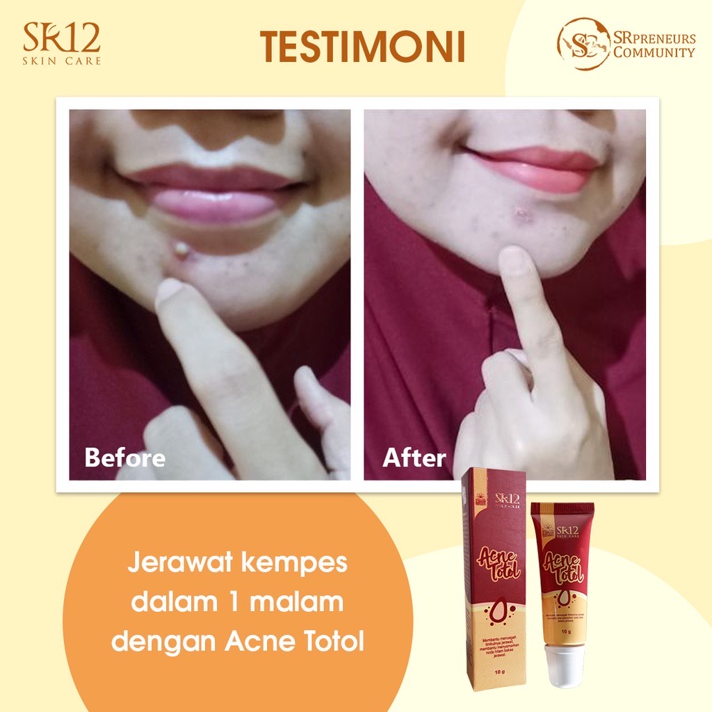 Obat Totol Jerawat Dan Penghilang Bekas Jerawat / Acne Totol SR12 / Acne Treatment Penghilang Jerawat Dan Bekasnya 10Gr