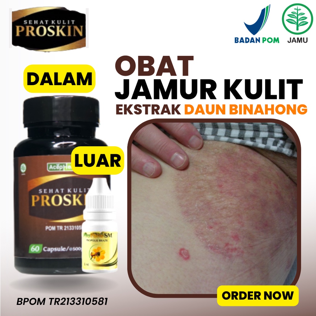 Jual Obat Jamur Kulit Selangkangan Panu Kadas Kurap Eksim Kering Basah