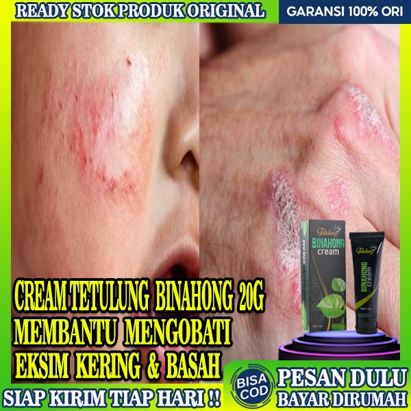Salep Eksim Basah Paling Ampuh,Obat Salep Eksim Kering Ampuh Basah,Obat Eksim Kulit Jamur Cream Bina