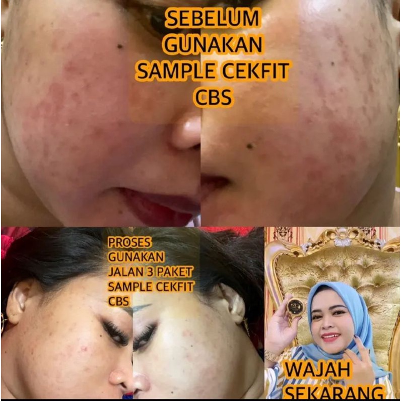 BPOM PAKET CBS CEKFIT BEAUTY SKINCARE JERAWAT DAN FLEK SABUN TONER CREAM