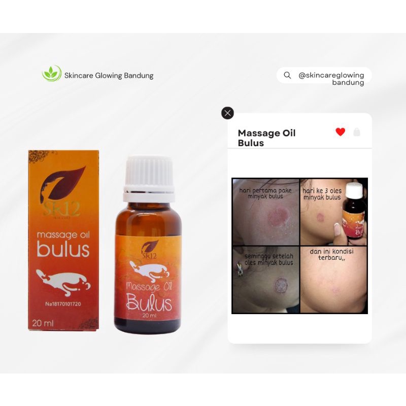 Paket Obat Gatal Sabun Bulus Minyak Bulus Obati Eksim Scabies Kudis Kurap Panu Obat Untuk Semua Gatal Kulit Obat Gatal Kulit Seluruh Badan Selangkangan Budug Santri Obat Kulit Borok Obat Gatel Obat Bentol Minyak Gatal Obat Selangkangan Lecet