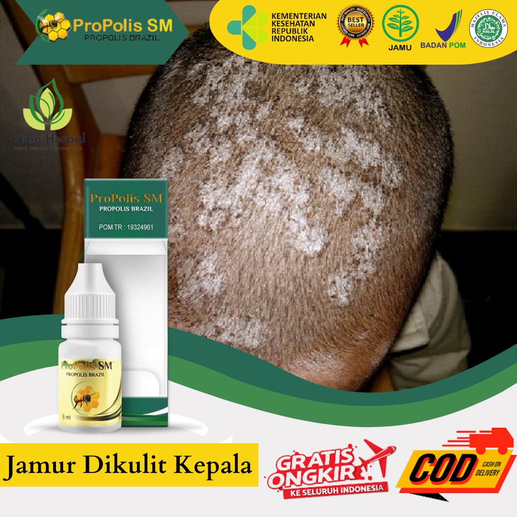 Obat Tinea Capitis, Obat Infeksi Jamur DiKepala, Obat Gatal Kulit Kepala, Obat Kulit Kepala Kering G
