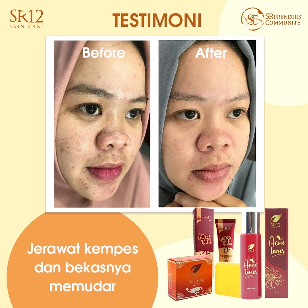 Obat Totol Jerawat Dan Penghilang Bekas Jerawat / Acne Totol SR12 / Acne Treatment Penghilang Jerawat Dan Bekasnya 10Gr