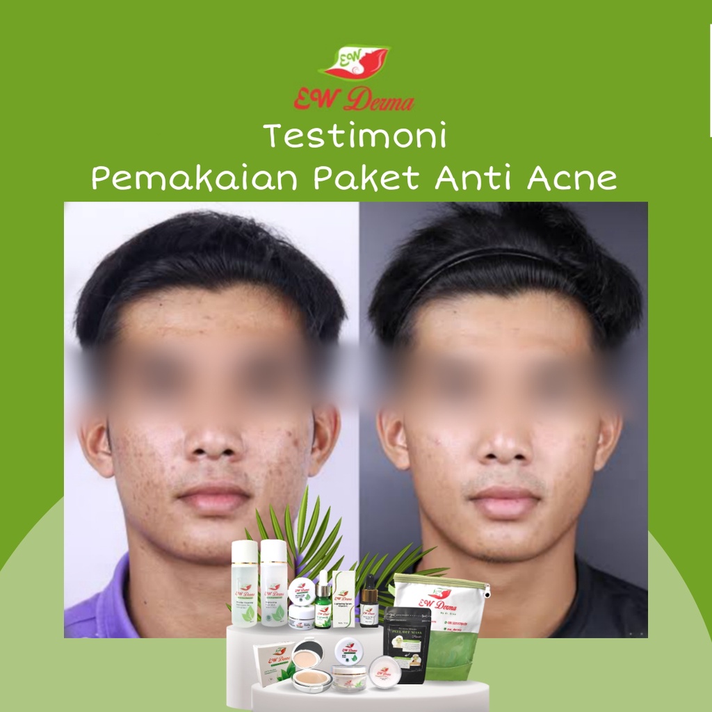 Obat Jerawat Pria Bopeng Bekas Jerawat Komedo Flek Hitam Cream Pemutih Cowok BPOM