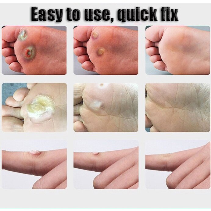 Obat Mata Ikan Penghilang Tahi Lalat Wart Removal 20g Repair And Clean Skin Tag Remover Di Wajah Menghilangkan pada mata/ wajah/ leher/ bagian tubuh/ Kapalan Di Tangan Dan Kaki Krim Antibakteri Krim Penghilang Kutil