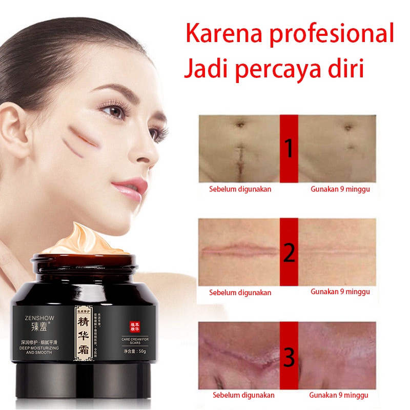 [COD] Original PENGHILANG BEKAS LUKA Penghilang Bekas Luka / Penghilang bekas luka Ekstrak tumbuhan salep luka bakar penghilang bekas jerawat mengembalikan