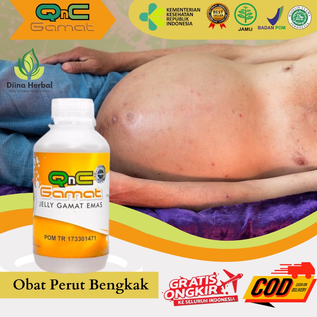 Obat Untuk Limpa Bengkak, Obat Asites Perut Bengkak, Obat Busung Air, Obat Liver Perut Bengkak, Peru