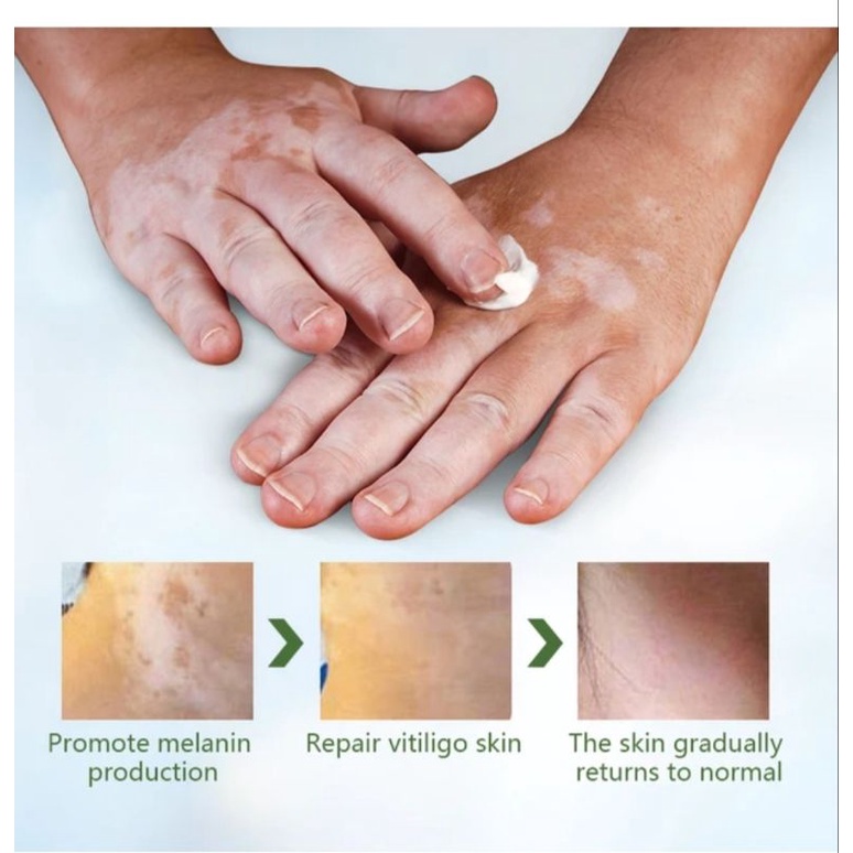 Salep Cream Vitiligo 20 gram Herbal Aman, Salep Cream Belang Herbal Aman, Salep Cream Bercak Herbal Aman