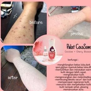 PAKET COCOSOM SERUM + LOTION Penghilang bekas luka koreng budukan + PEMUTIH di kulit KOREAN GLASS SK