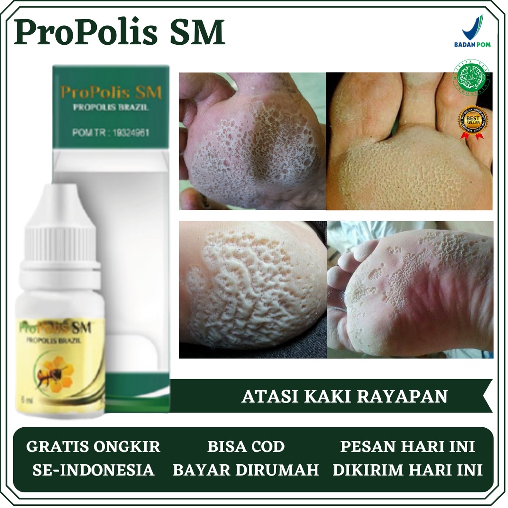 Obat Kaki Rayapan, Obat Telapak Kaki Bolong Kecil, Obat Telapak Kaki Rayapan dan Bau, Obat Jamur di 