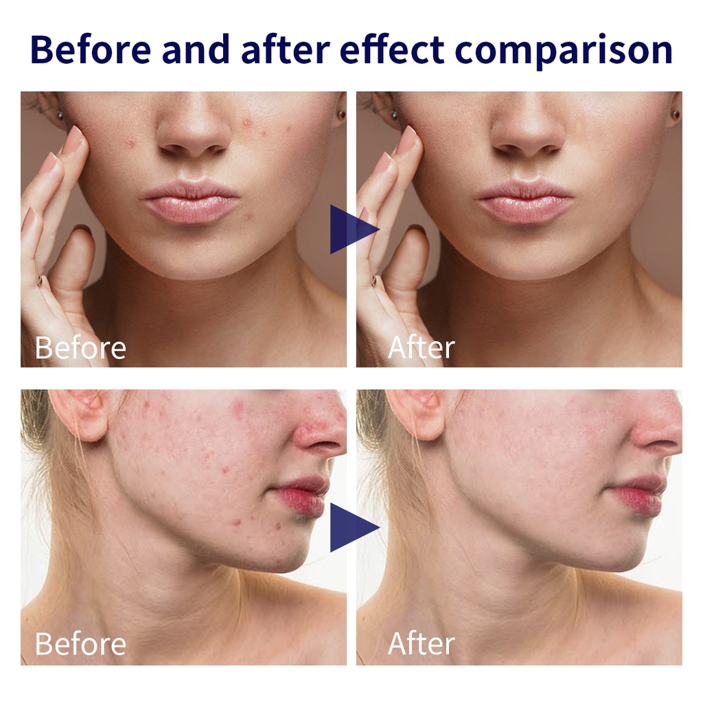 YOUBUY Brightening Serum Niacinamide - Serum Pencerah Wajah Intensif Dengan Niacinamide, Hyaluronic  Essence 30ml