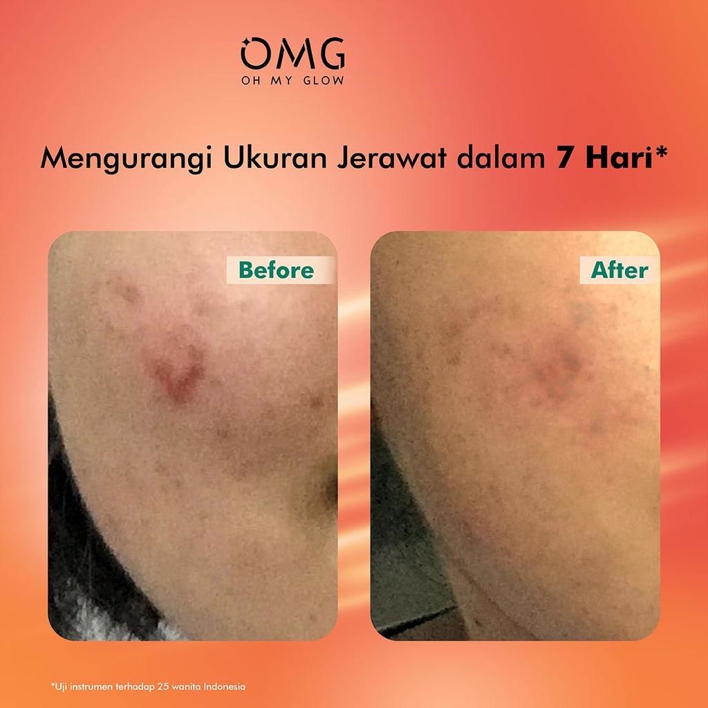 ★ BB ★ OMG Oh My Glow Mugwort Acne Serum 20 ml - Peach Glowing Serum 20ml | Serum Perawatan Kulit Berjerawat