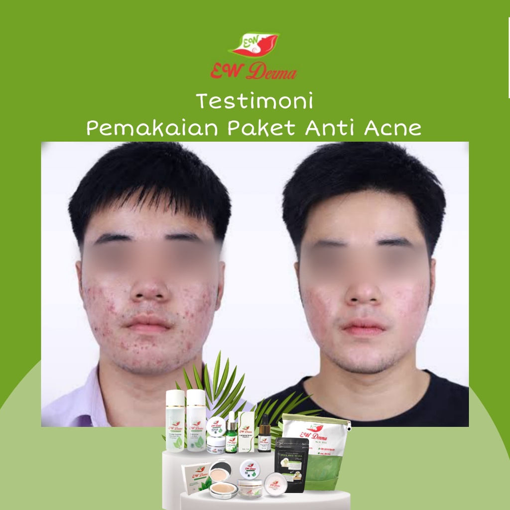 Obat Jerawat Pria Bopeng Bekas Jerawat Komedo Flek Hitam Cream Pemutih Cowok BPOM