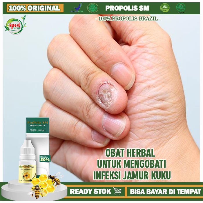 Obat Buat Infeksi Jamur Kuku,  Mengatasi Infeksi Jamur Kuku Cantengan Dan Bernanah, Obat Psoriasis K