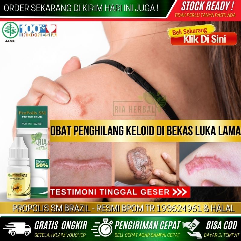 Obat Untuk Menghilangkan Keloid Yang Sudah Lama, Obat Penghilang Keloid Luka Tindik, Keloid Daging T